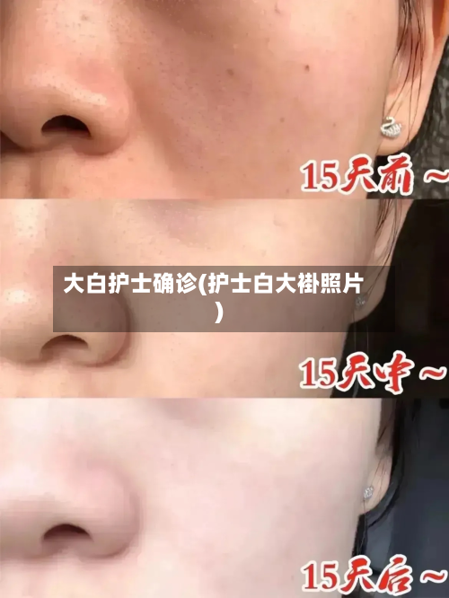 大白护士确诊(护士白大褂照片)