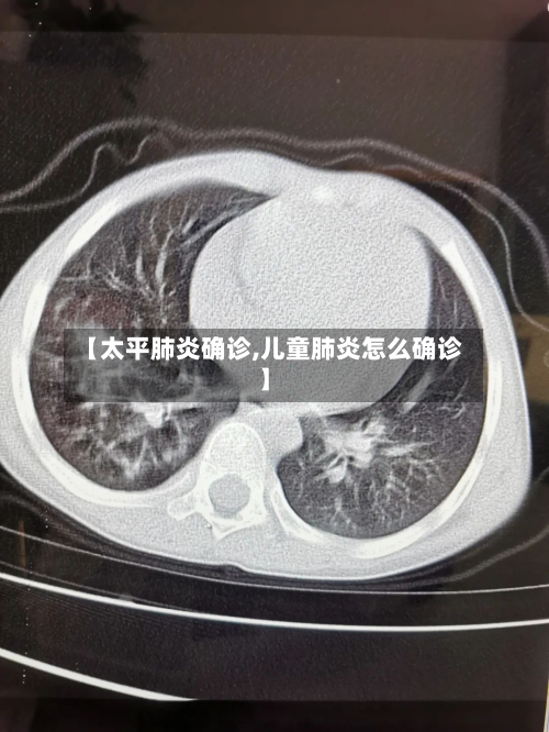 【太平肺炎确诊,儿童肺炎怎么确诊】