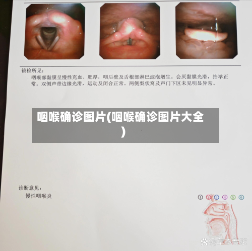 咽喉确诊图片(咽喉确诊图片大全)
