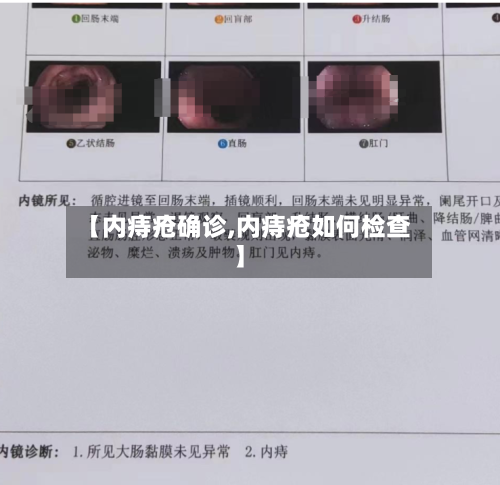 【内痔疮确诊,内痔疮如何检查】